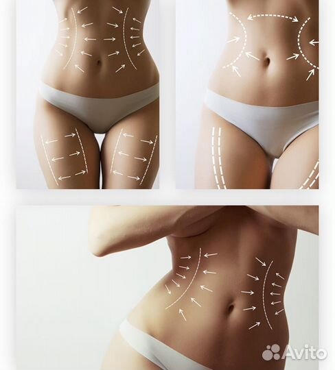 LPG массаж и Emsculpt