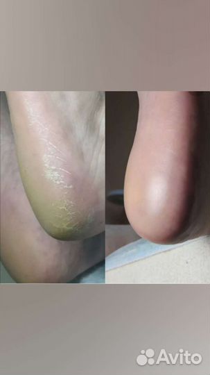 Педикюр Мытищи