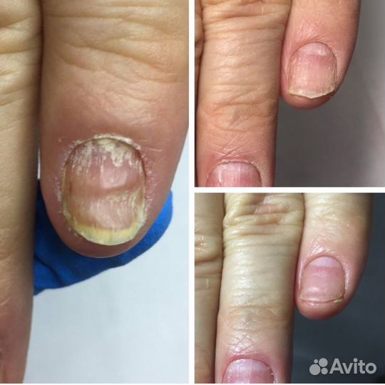 Подолог: Вросший ноготь. Мозоли. Трещины. Грибок