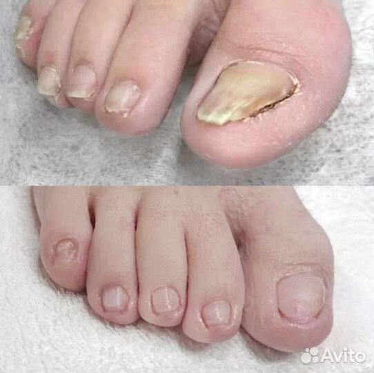 Педикюр(подология)