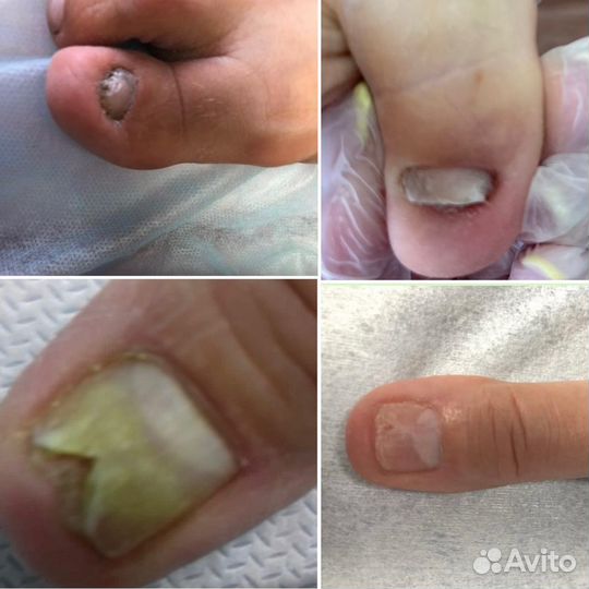 Педикюр. Подология