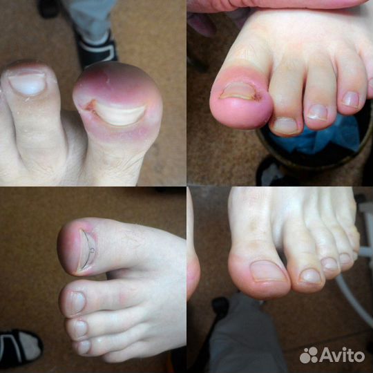 Лечебный педикюр