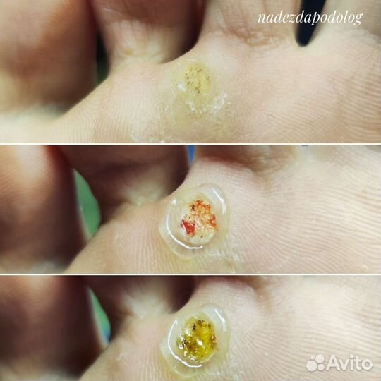 Подолог, педикюр, ортопедические стельки, обучение