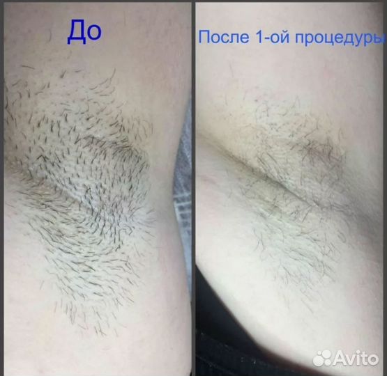 Мастер электроэпиляции