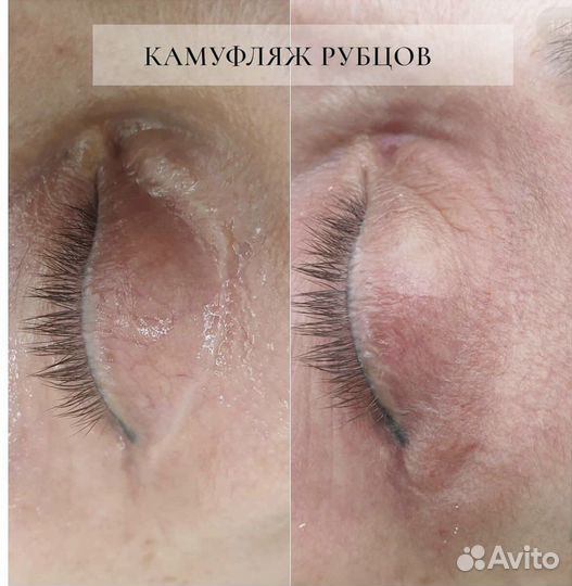 Камуфляж шрамов