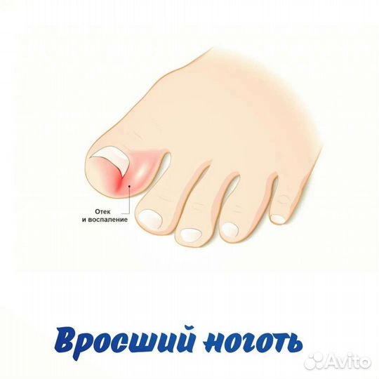 Педикюр, парамедицинский педикюр