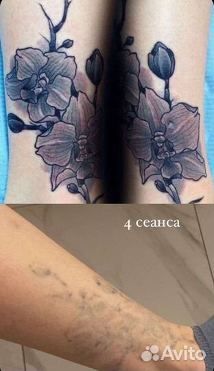Удаление татуировок и татуажа