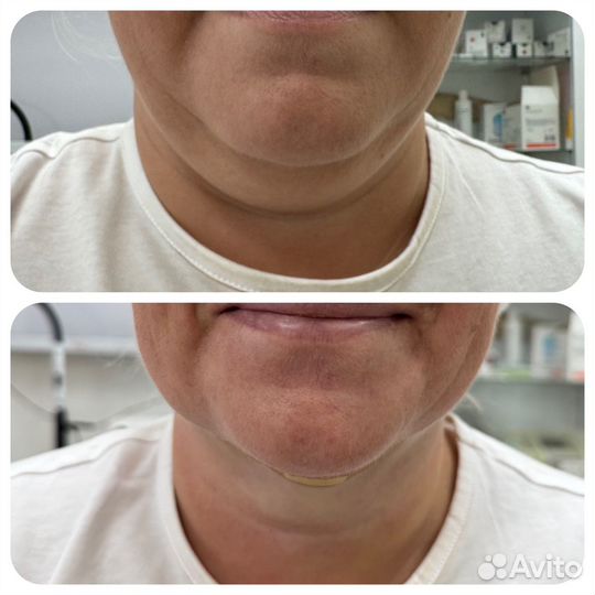 Иньекционная косметология и не только