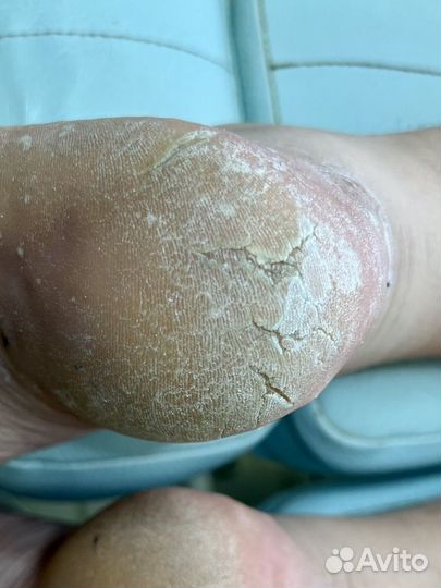 Подологический педикюр