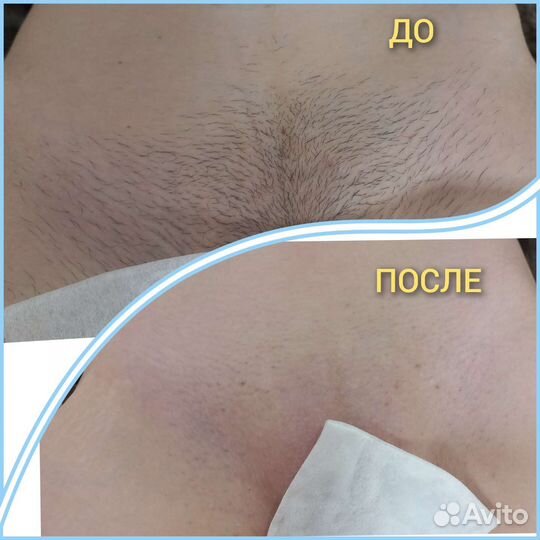 Модель на депиляцию за расходники Девушки