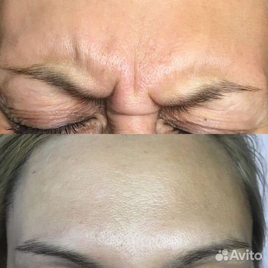 Ботокс для лица