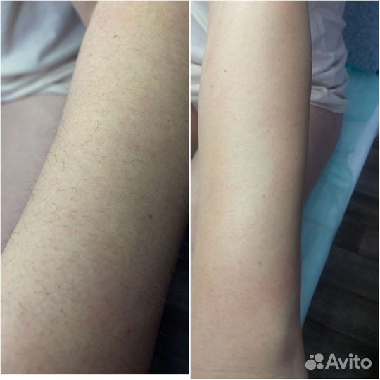Депиляция воском