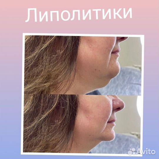Липолитики мезотерапия