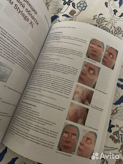 Книга по инъекционной контурной пластике