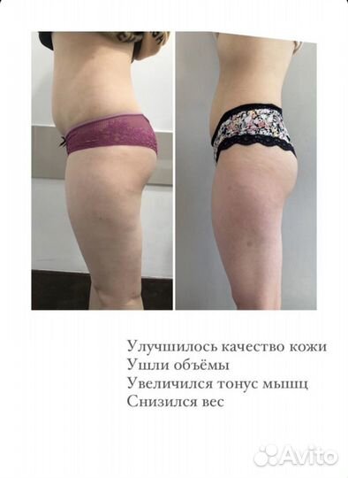 Похудение, Миостимуляция, Kоррекция фигуры