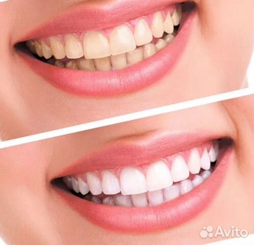 Уф лампа для отбеливания зубов