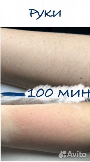 Электроэпиляция: бёдра