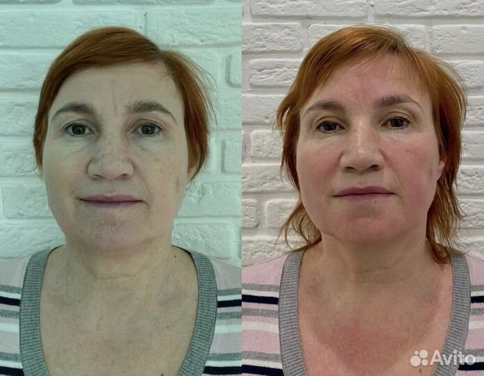 Массаж лица и тела Остеопластика