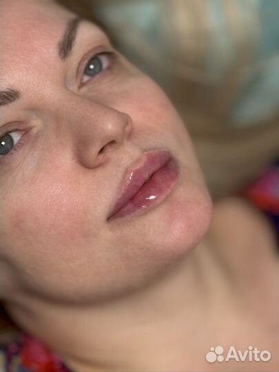Увеличение губ