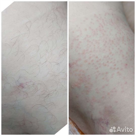 Электроэпиляция