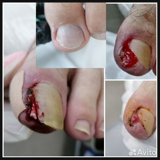 Вросший ноготь, Подология, Педикюр