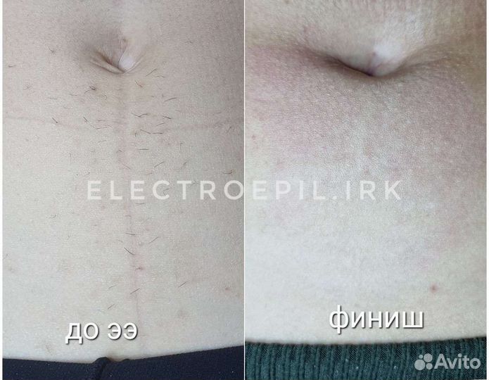 Электроэпиляция: глубокое бикини