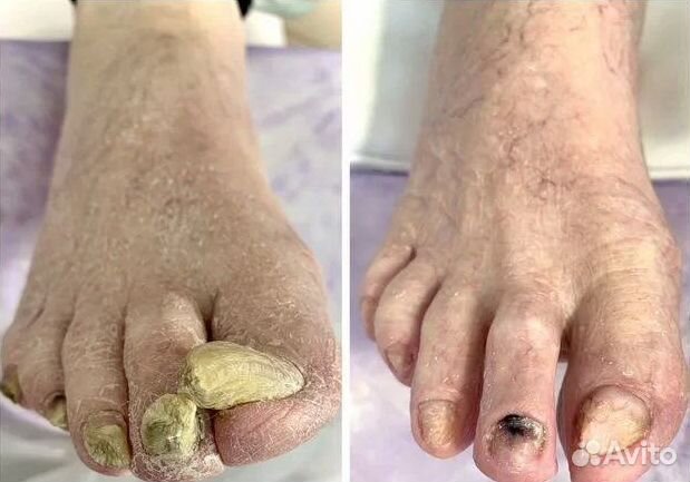 Медицинский педикюр, подолог