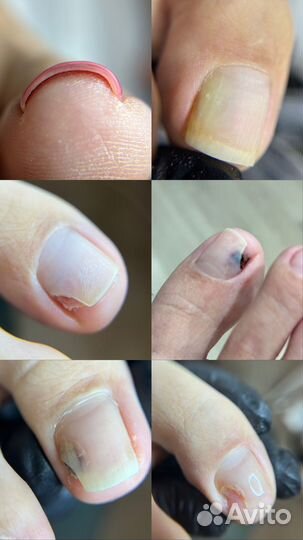 Модель на вросший ноготь