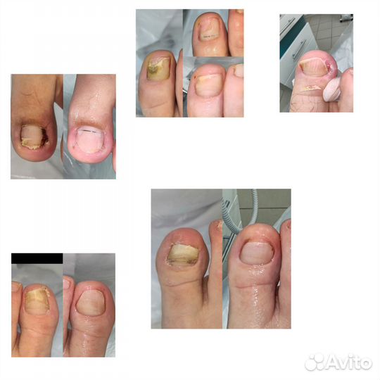 Титановая нить