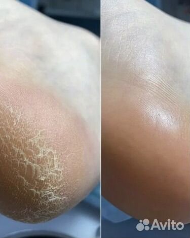 Подолог педикюр любой сложности, вросший ноготь