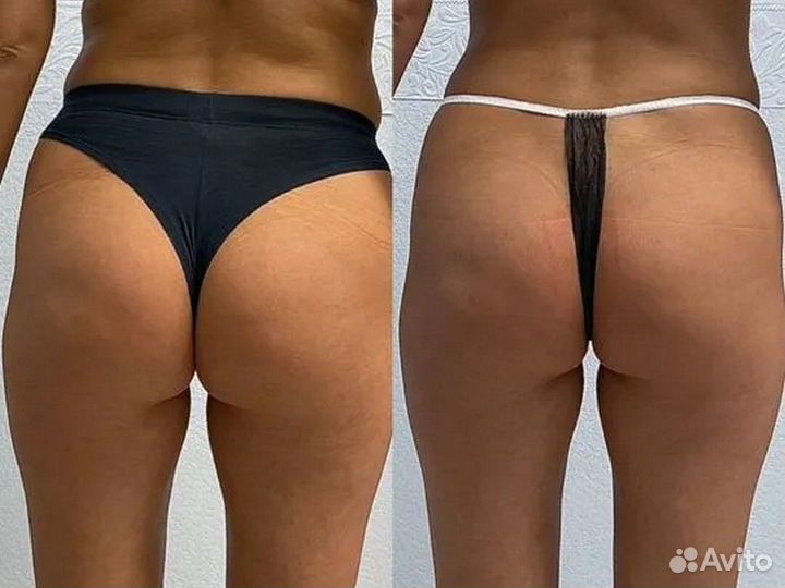 Аппаратный массаж / коррекция фигуры