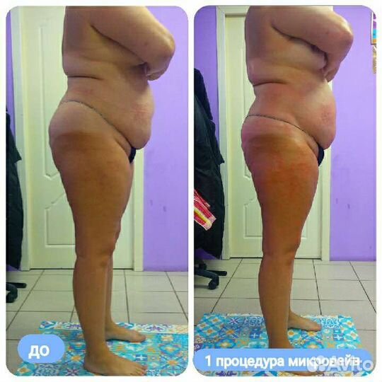 Массаж-коррекция фигуры