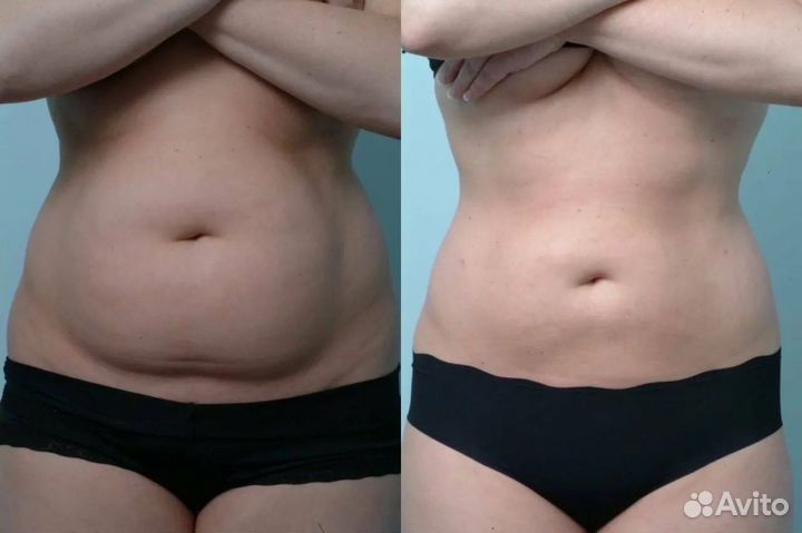 LPG массаж - целлюлита как и не бывало