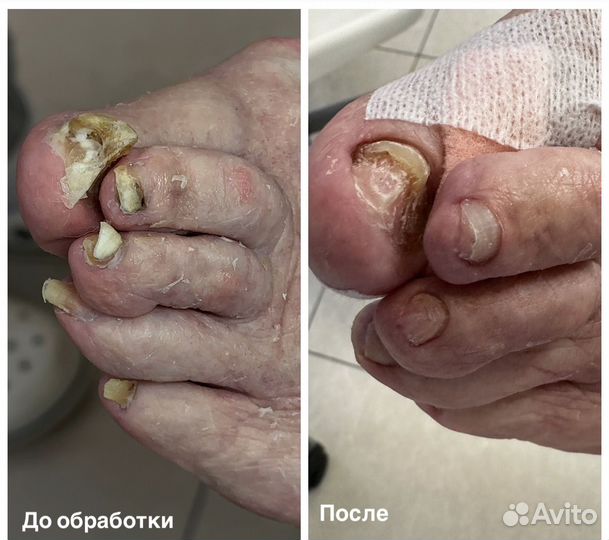 Подолог, педикюр