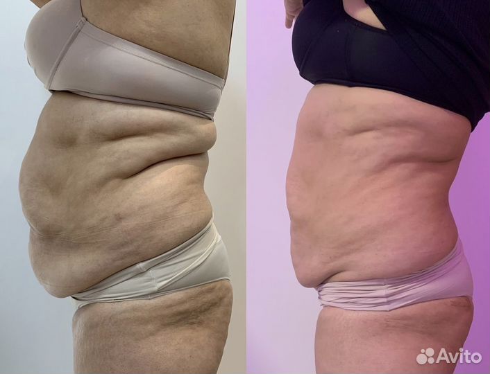 Криолиполиз