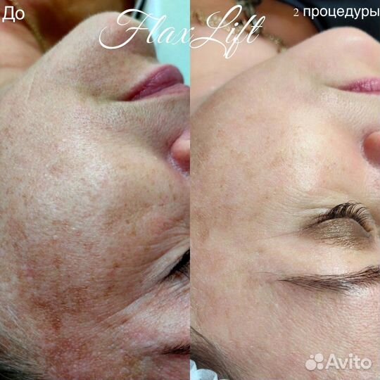 Косметолог, чистка лица, омоложение