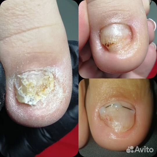 Педикюр. Подология. Ортониксия