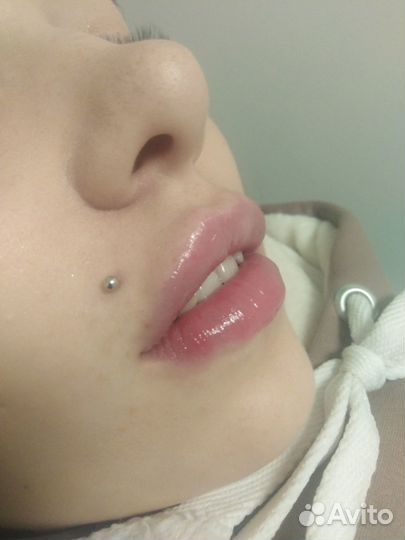 Увеличение губ,Ботокс,Липолитик,Биоревитализация