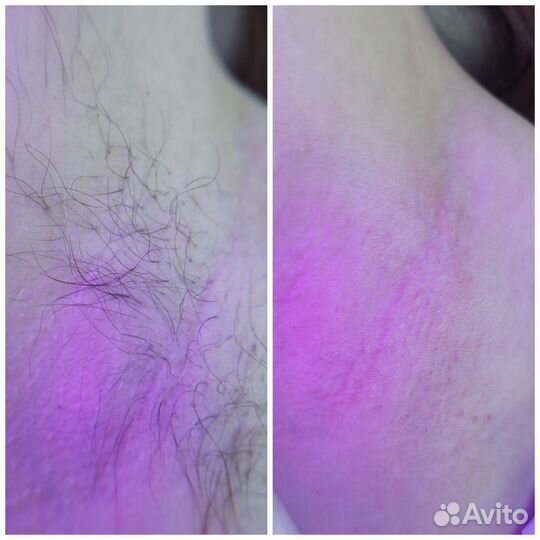 Депиляция/Воск/Шугаринг