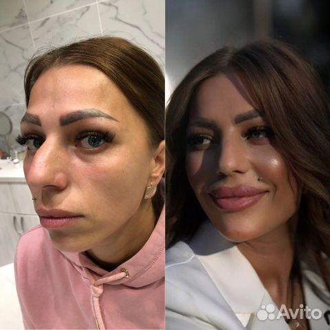 Лицо под ключ до и после