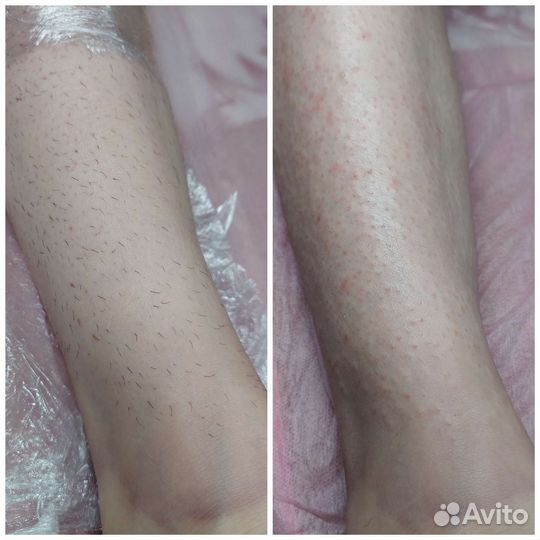 Электроэпиляция
