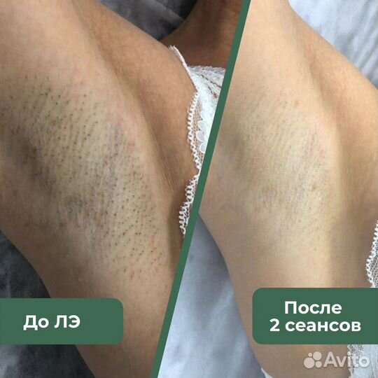 Лазерная эпиляция для женщин и мужчин по Зонам