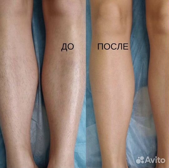 Лазерная эпиляция: подмышки