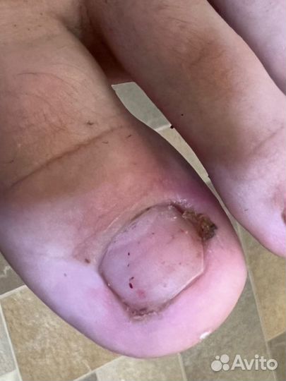 Педикюр сложных стоп