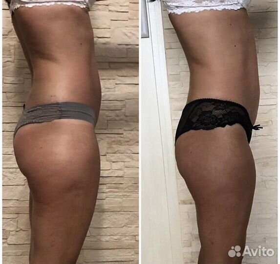 Антицеллюлитный массаж, массаж лица. Эффект сразу