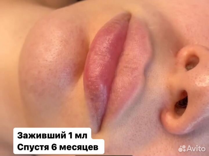 Увеличение губ без боли