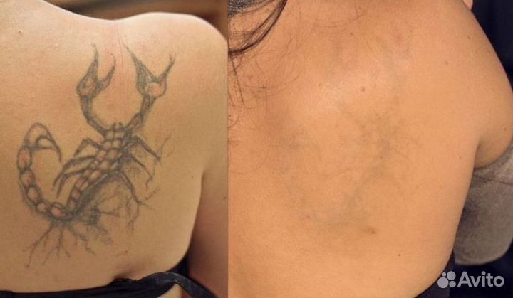 Удаление татуировок