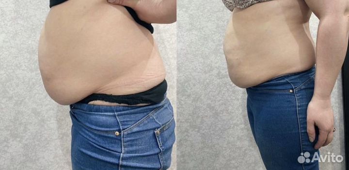 Жиротоп. Липолитики для тела у топ-косметолога