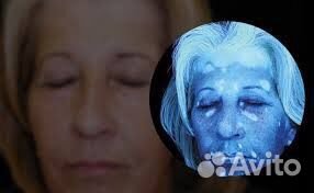 Лампа Вуда для диагностики кожи