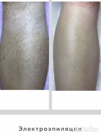 Электроэпиляция